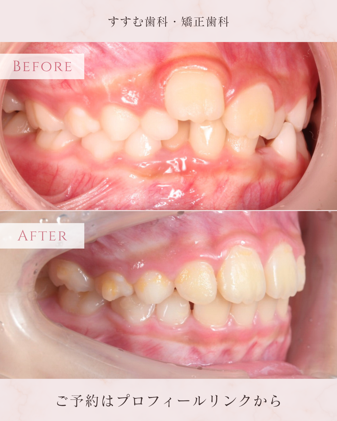 小児矯正症例】前歯のガタガタ・スペース不足を1年8ヶ月で改善！7歳